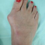 Essential guidelines for the bunion patients